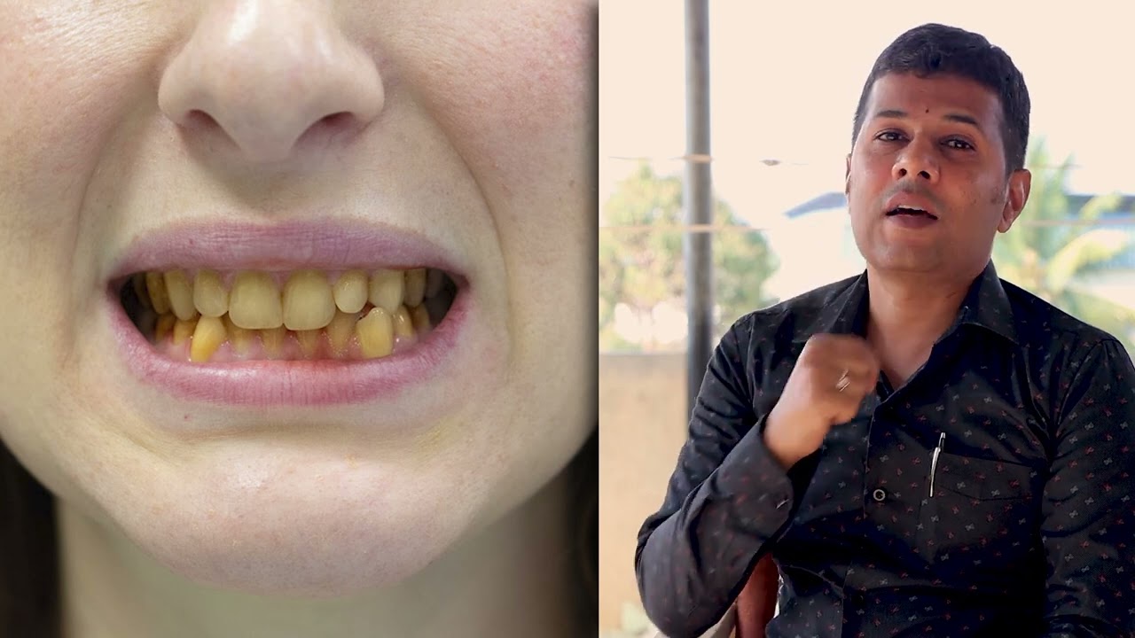 ಹಳದಿ ಹಲ್ಲು ಹಾಲಿನಂತೆ ಬೆಳ್ಳಗೆ ಹೊಳೆಯಬೇಕೆ? Teeth Whitening | Hallu Bellagagalu