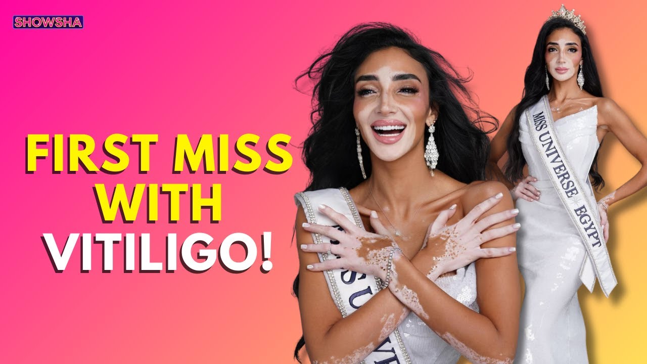 Miss Egypt Universe, First-Ever Contestant With Vitiligo Champions Body Positivity, Inclusivity