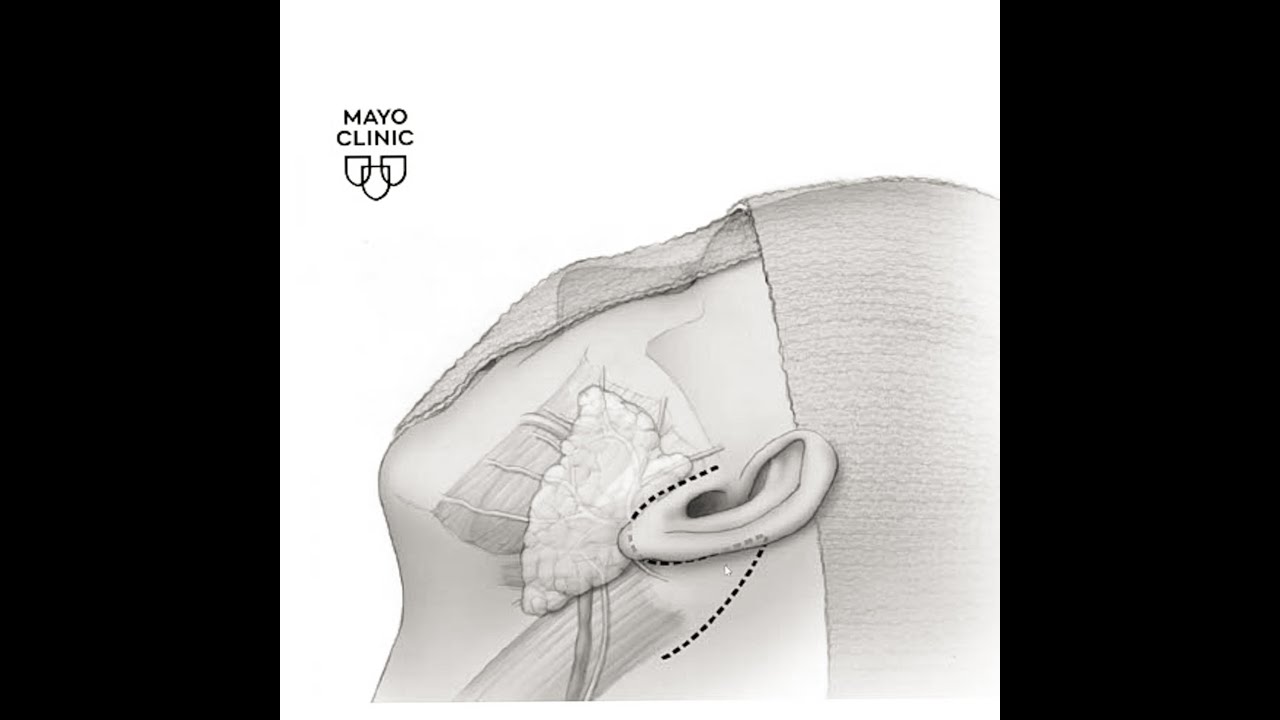 Mayo Clinic Parotid Tumor Guide: Incisions & Healing