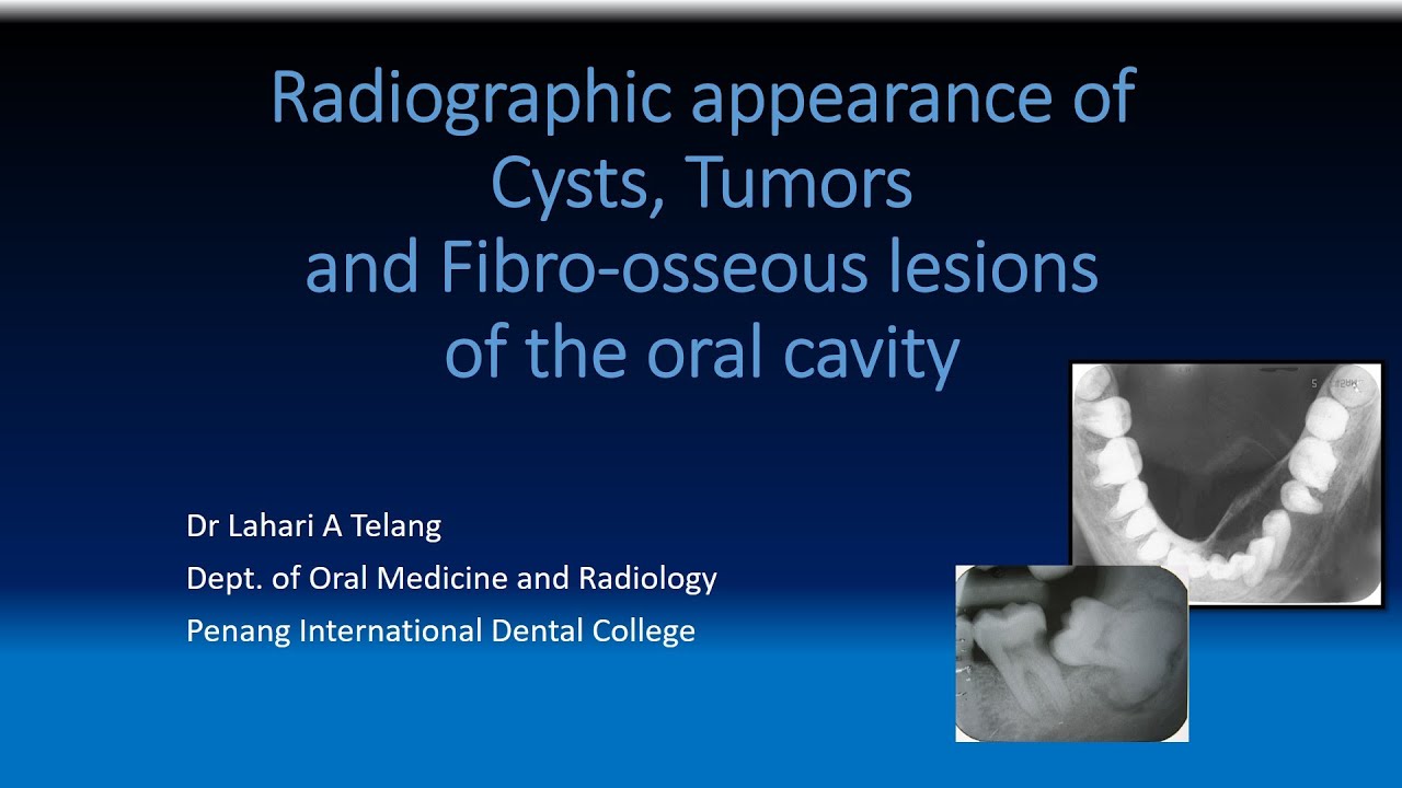 Radiographic appearance of cysts, tumors and fibro osseous lesions of the oral cavity