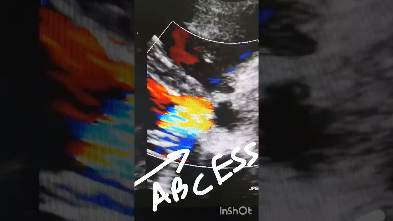 Aortic Root Abcess+ Infective Endocarditis of Aortic Valve