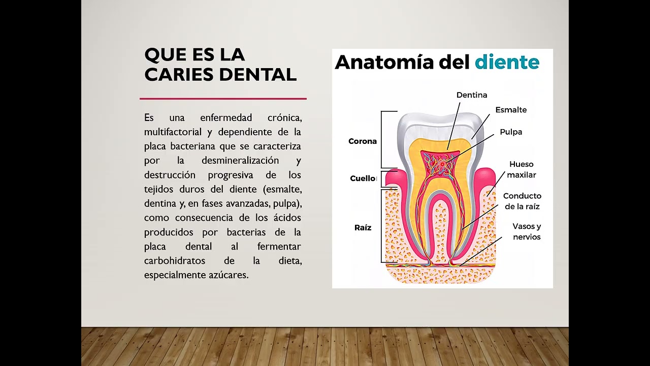 Caries Dental: Todo lo que necesitas saber!!