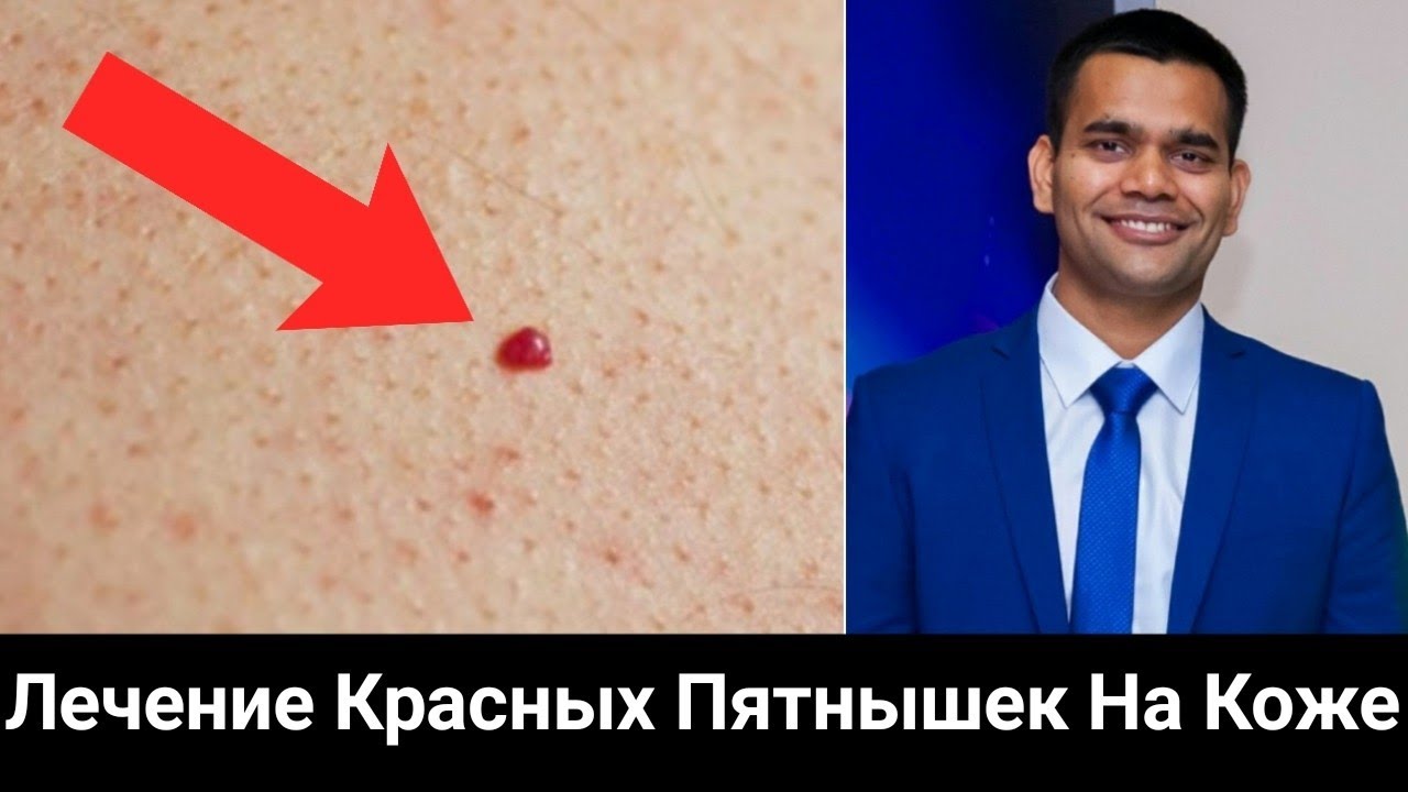 Лечение красных пятнышек на коже.