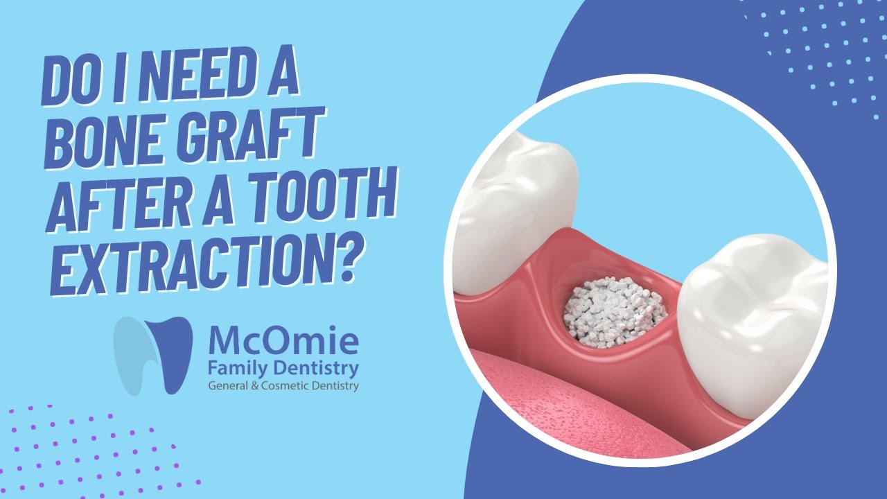 Do I Need A Bone Graft After A Tooth Extraction? Chattanooga Dentist Dr. McOmie Explains
