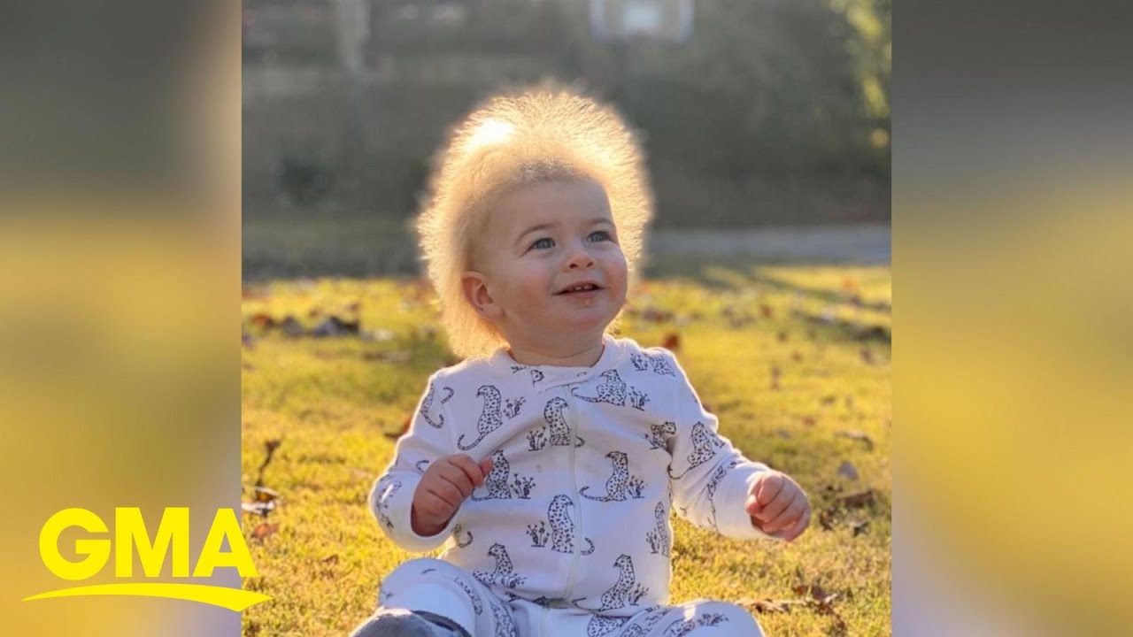 One-year-old boy has extremely rare ‘uncombable hair syndrome’ l GMA