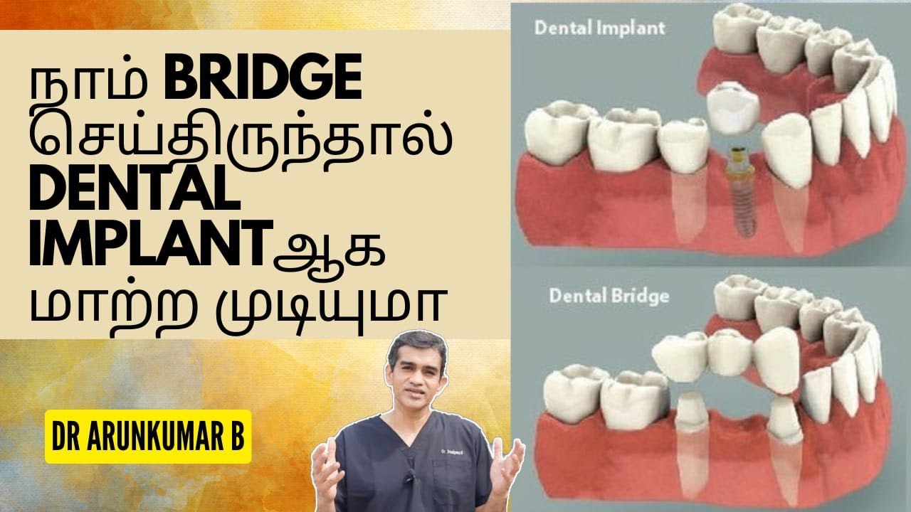 நாம் Bridge செய்திருந்தால் Dental Implantஆக  மாற்ற முடியுமா | Dr Arunkumar Pearls Dentistry Chennai