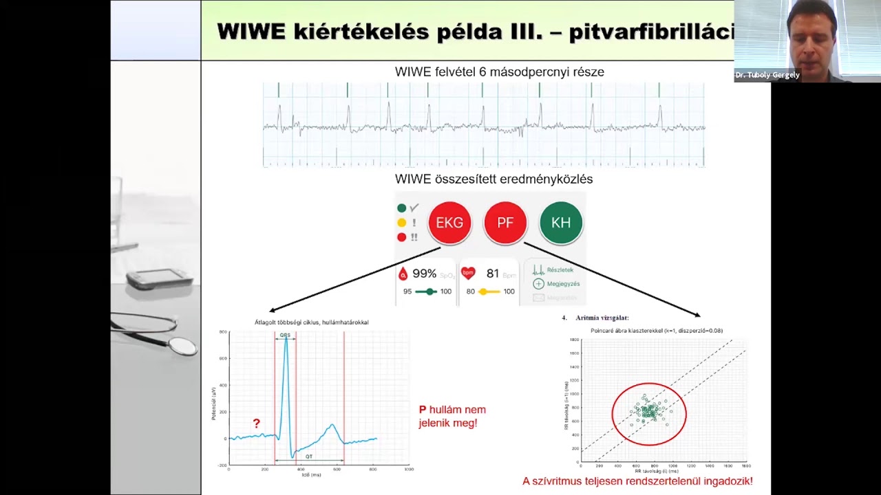 Középpontban a pitvarfibrilláció!  - dr. Tuboly Gergely előadása