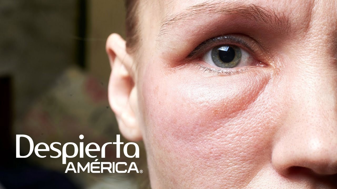 &iquest;Sufres de hinchaz&oacute;n en la cara? Estas podr&iacute;an ser las posibles causas | Dr. Juan