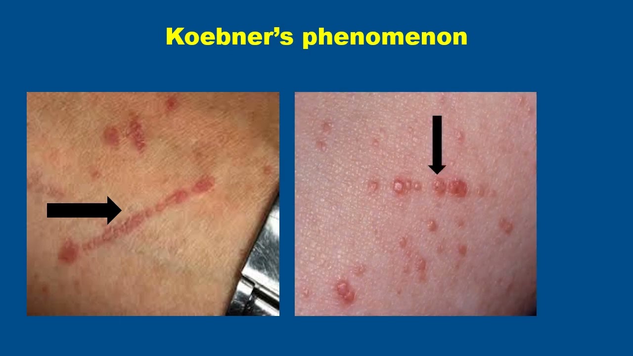 Lichen Planus PPT for Medical Students