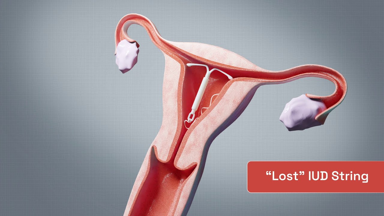 3D Surgical Animation: OBIS IUD Remover Instructional Video