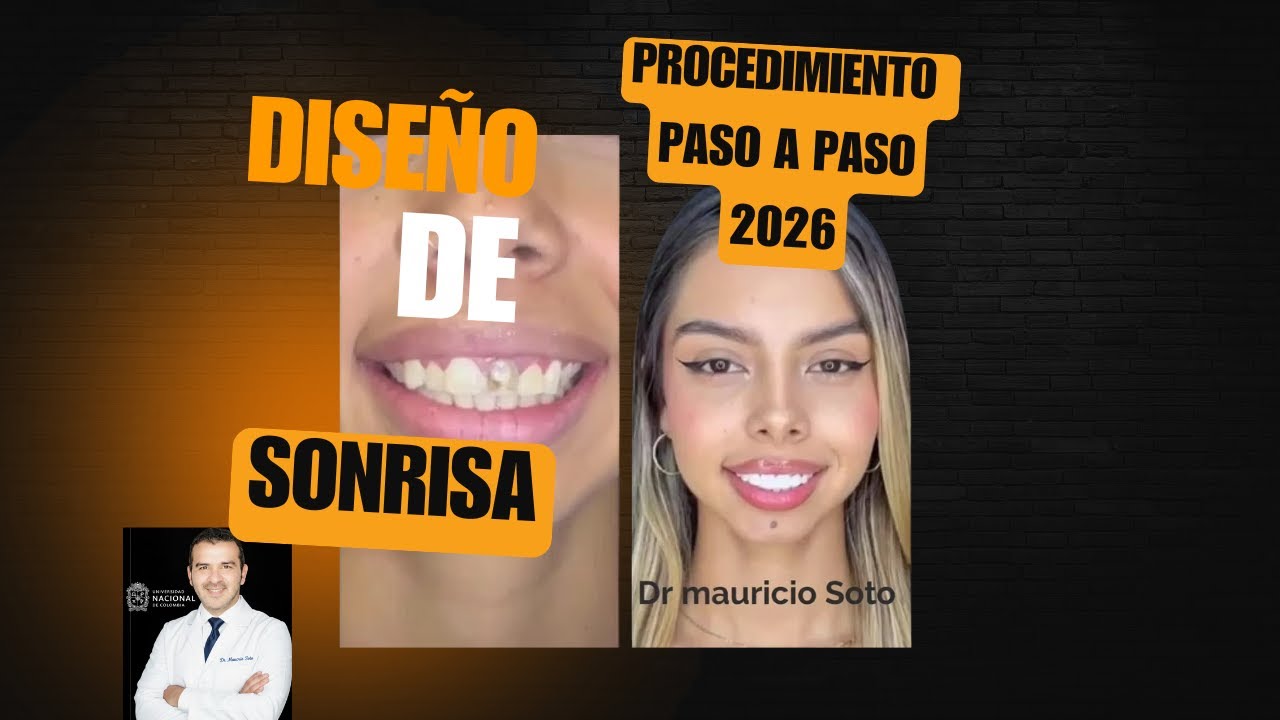 Protocolo Paso a Paso  de Carillas de Resina : Caso Completo