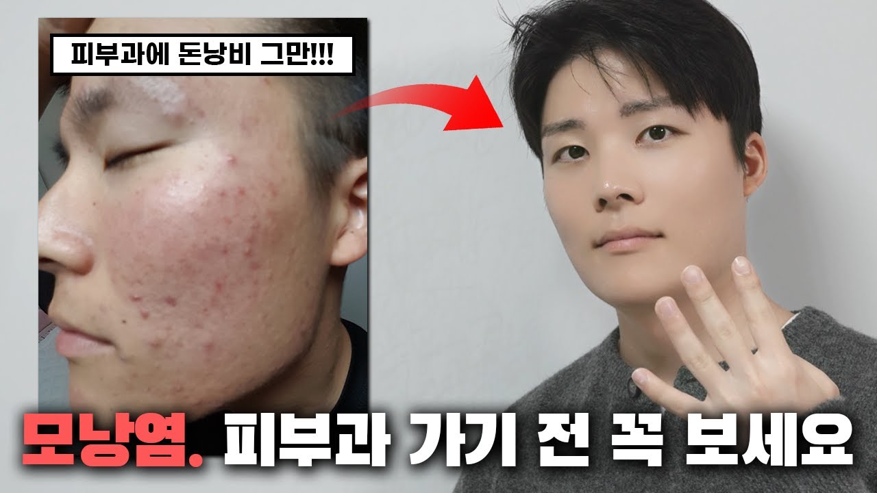 모낭염 그렇게 하면 절대 안낫습니다... 모낭염 vs 여드름 구분법. 피부과 가기전에 꼭 보세요.