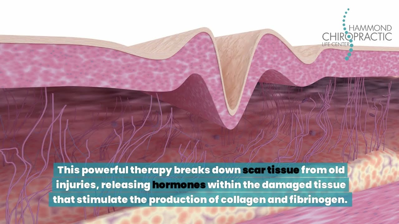 Shockwave Therapy for Chronic Pain at Hammond Chiropractic