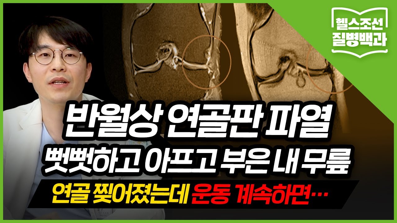 [반월상 연골판 파열] 연골 찢어져도 걸을 순 있지만… 방치하면 봉합도 불가능 | 질병백과