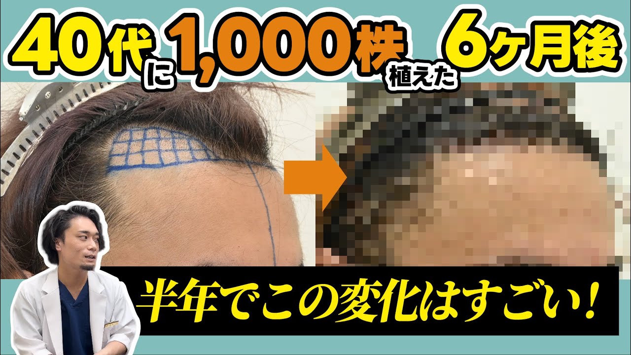 【自毛植毛】1000グラフトの植毛手術で生え際はこれくらい改善できます
