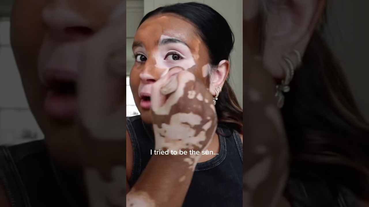 Born to be both &hearts;️&hearts;️ #vitiligo #skin #makeup #makeuplover #trending #girls #makeupshorts #love