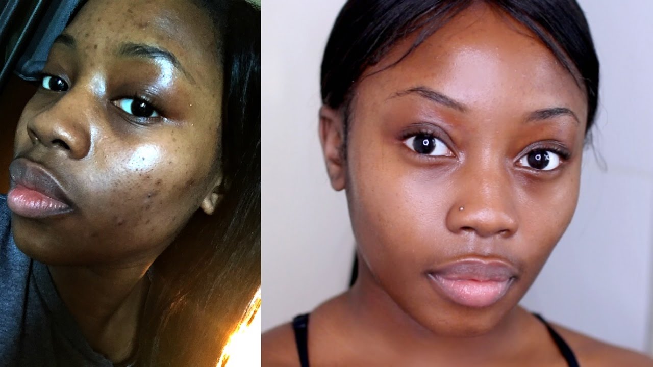 How to: get rid of acne scars morning routine 2016 | Lizzie loves skincare