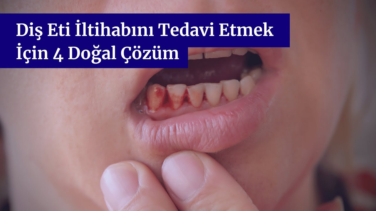 Diş Eti İltihabını Tedavi Etmek İçin 4 Doğal Çözüm