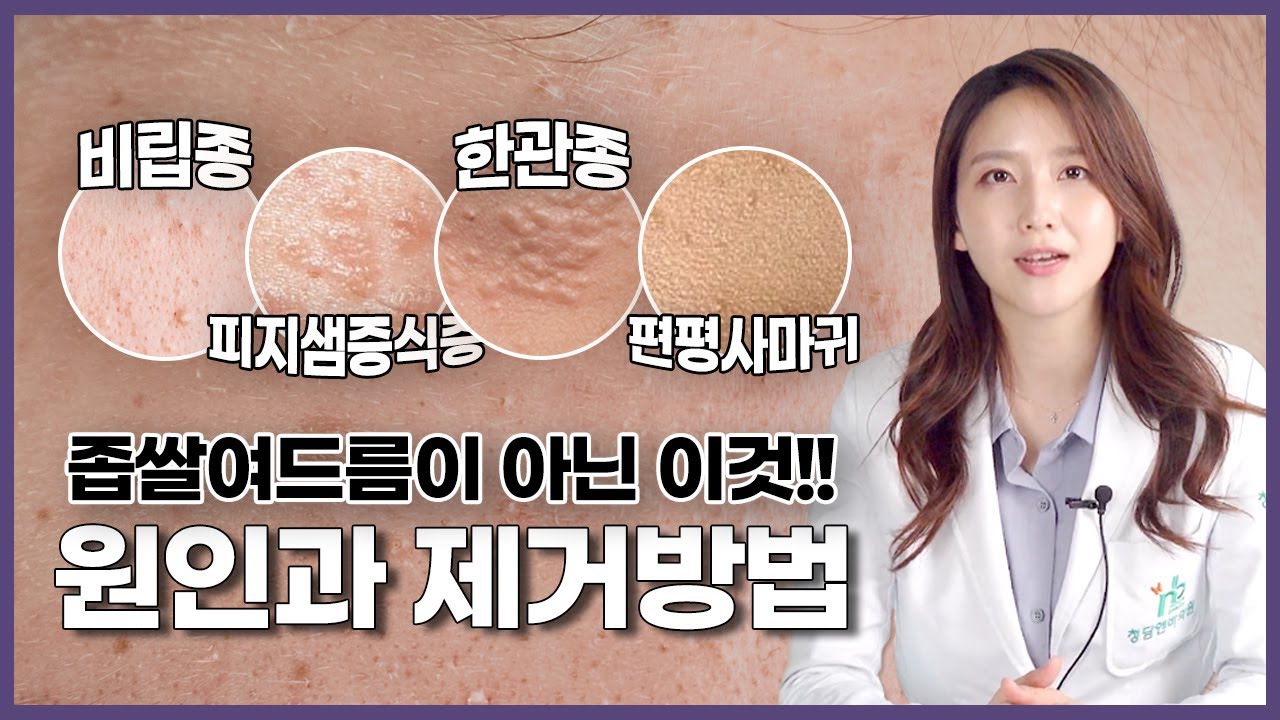 비립종 한관종 피지샘증식증 편평사마귀! 좁쌀여드름이아니라고? 원인부터 확실한 치료방법까지❗