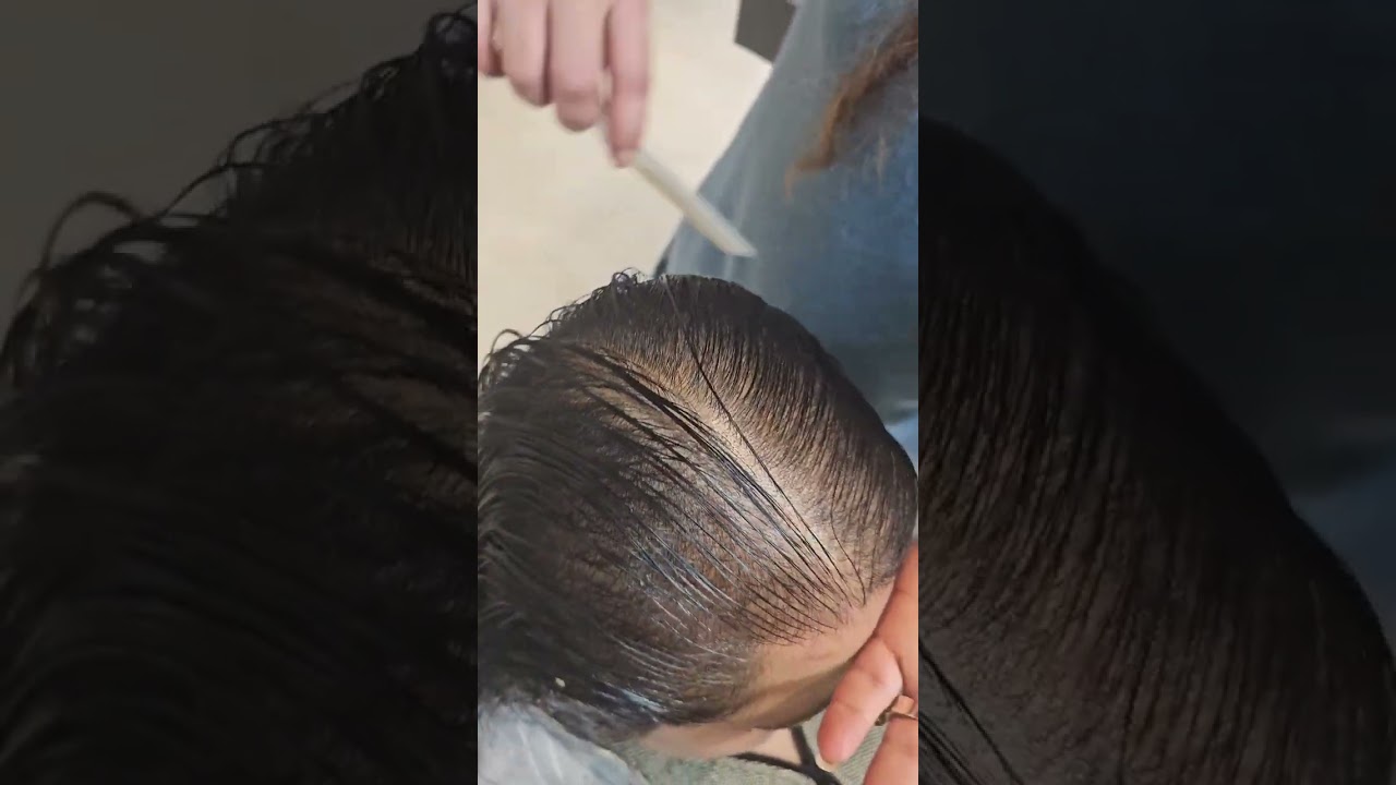 100% RECOVERY OF FEMALE BALDNESS PATTERN