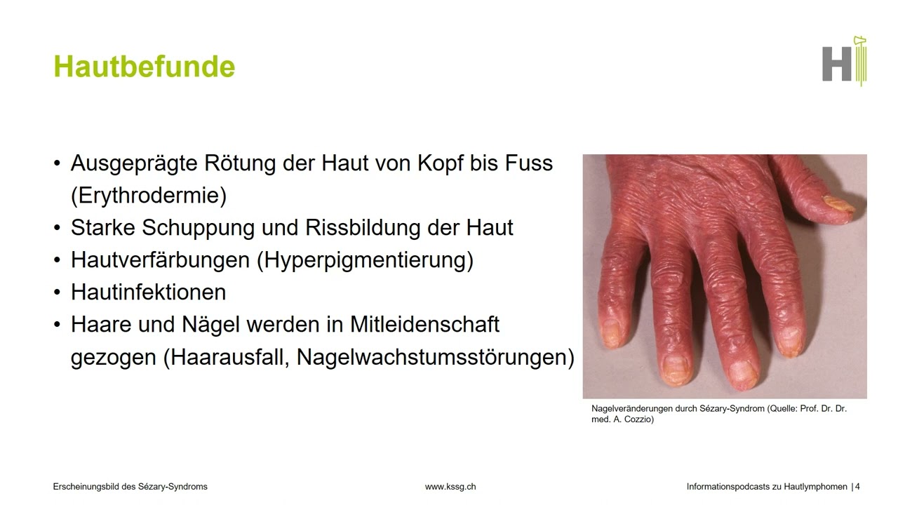 4. Erscheinungsbild des Sézary-Syndroms – Präsentationsreihe zu Hautlymphomen