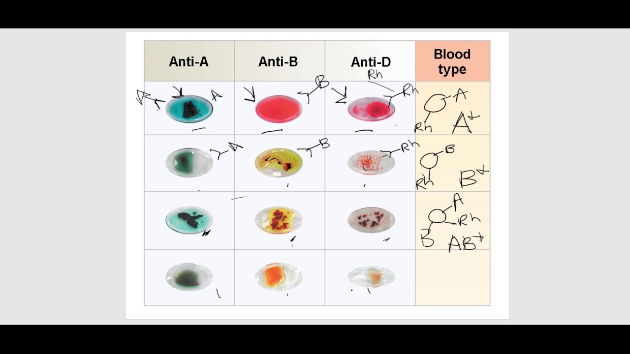 The Blood Part 3: Blood Typing and Transfusions