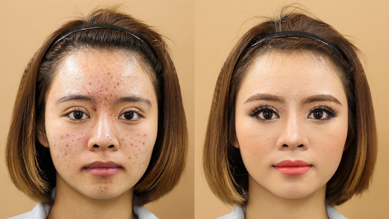 Trang Điểm Cô Dâu Da Mụn, Cách Xử Lý Da Mụn [TRANG SUN MAKEUP]