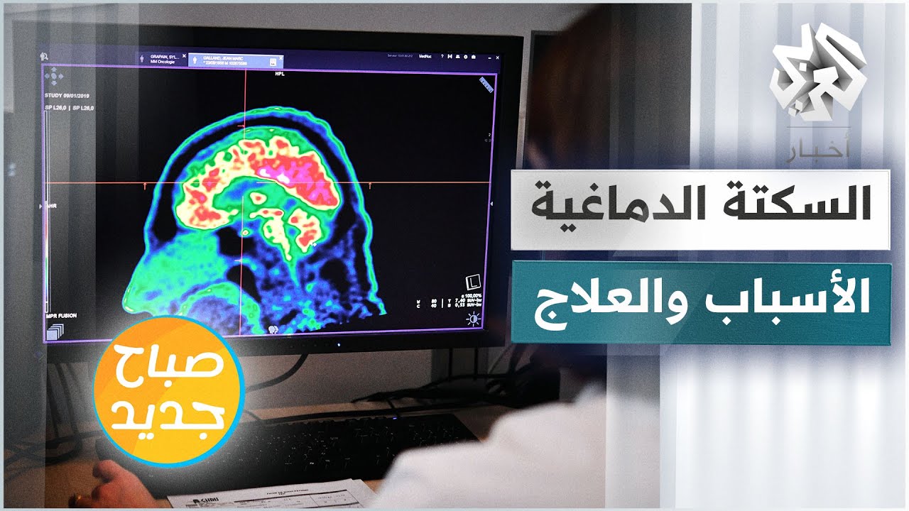 السكتة الدماغية .. كيف تحدث وما هي علامات الإصابة بها وكيف يمكن علاجها؟