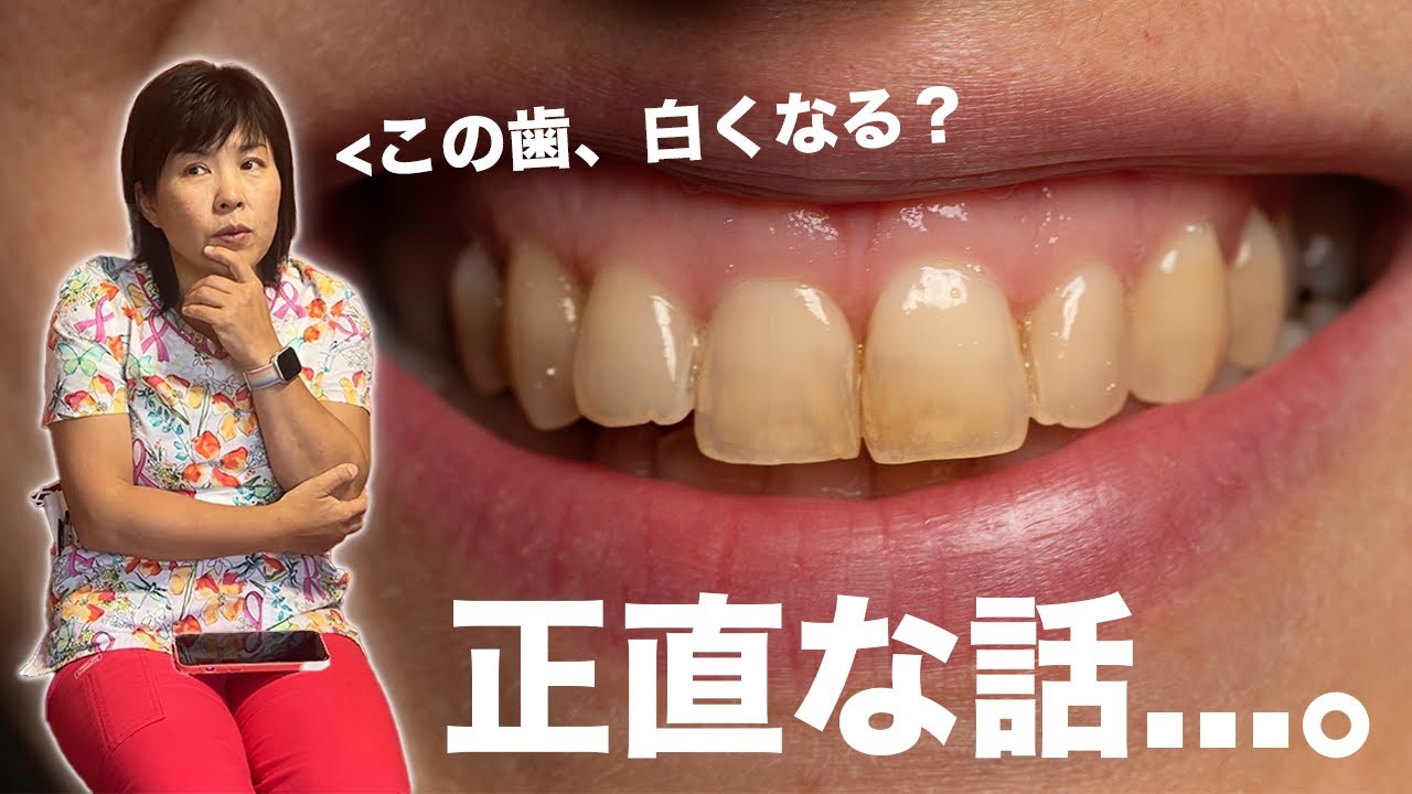 【ホワイトニング】する前に知りたかった...。