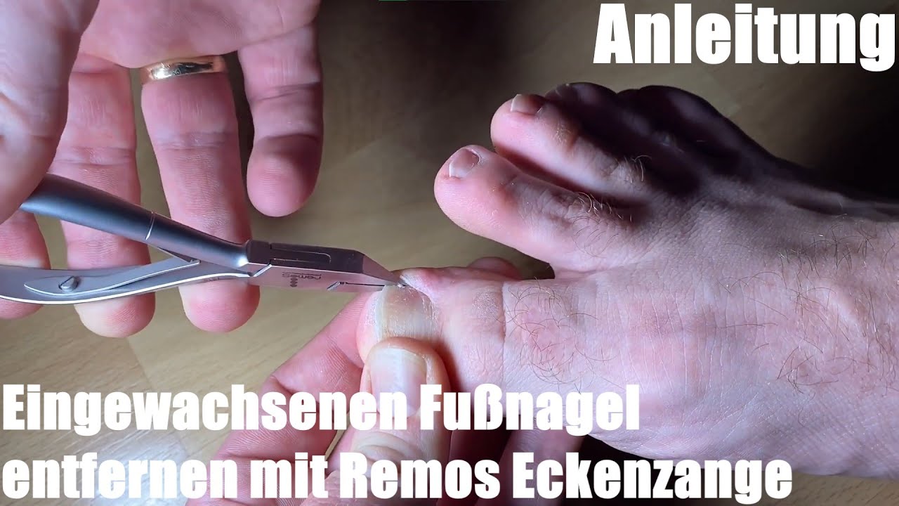 Eingewachsenen Fußnagel entfernen mit Remos Eckenzange 10cm, schlanke Spitze Pediküre Anleitung