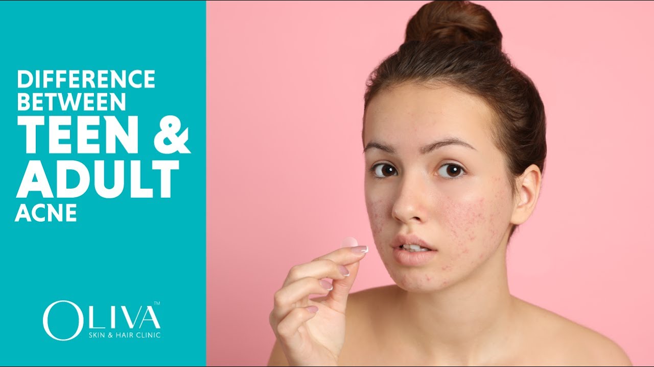 Know The Difference Between Teen & Adult Acne | How To Treat Effectively