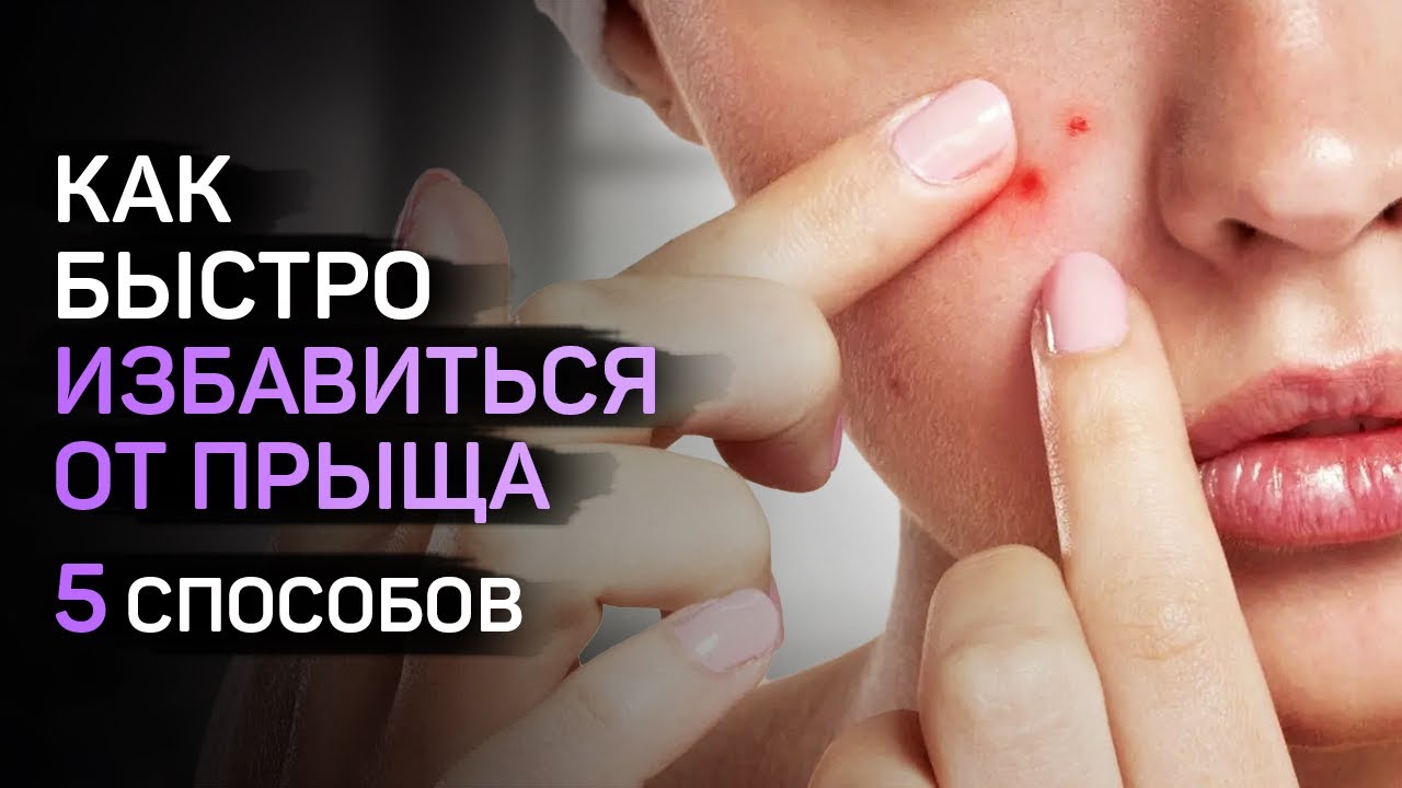 Как быстро избавиться от прыщей? 5 Эффективных SOS средств от высыпаний.