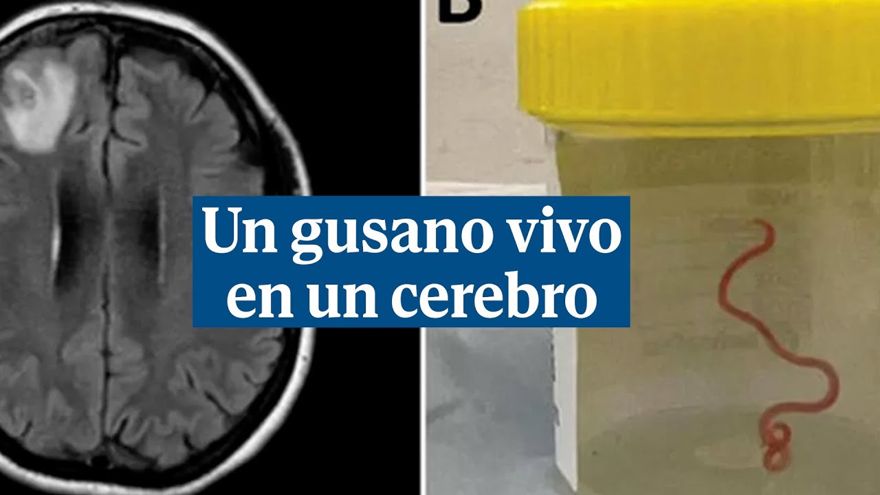 Encuentran un gusano vivo en el cerebro de una mujer australiana