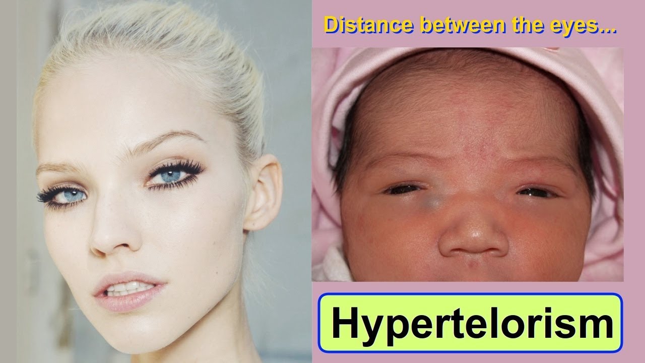 hypertelorism