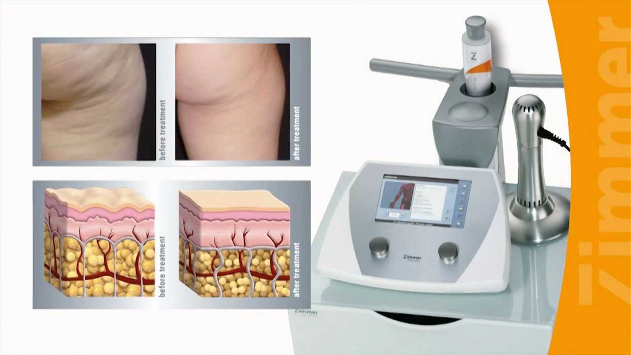 ZWave - Cellulite treatment with radial shockwaves.