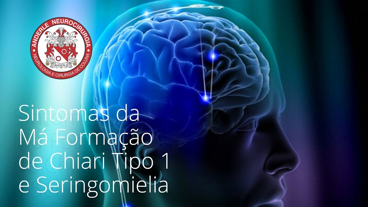 SINTOMAS da Má Formação de Chiari tipo 1 e Seringomielia - Dr Diogo - Neurocirurgião