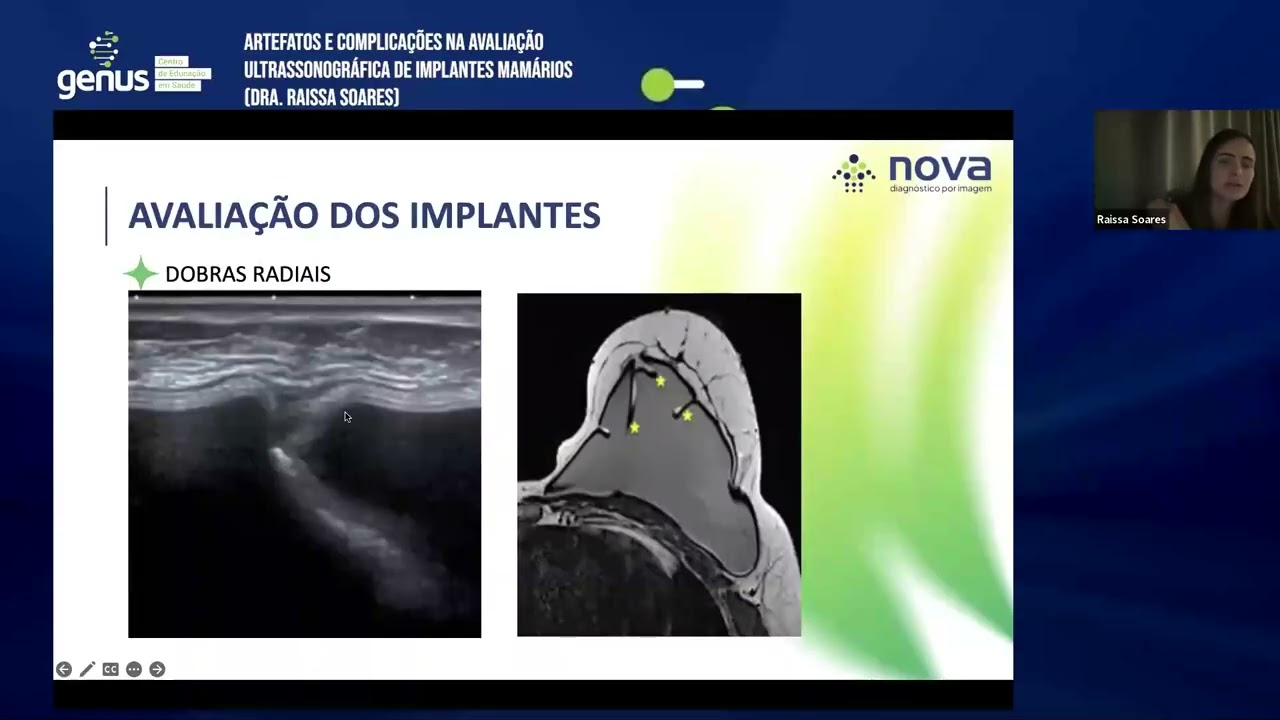 Tema: Artefatos e Complicações em Implantes Mamários com Dra. Raissa Soares