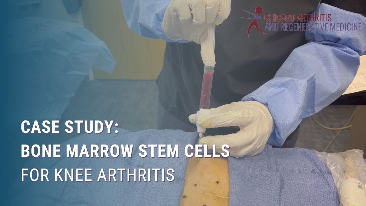 Case Study: Bone Marrow Stem Cells for Knee Arthritis