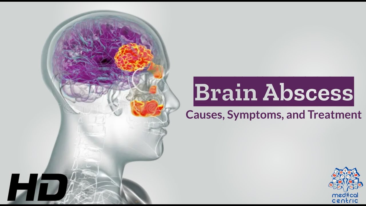 Brain Abscess Unveiled: Causes, Symptoms, and Lifesaving Treatments