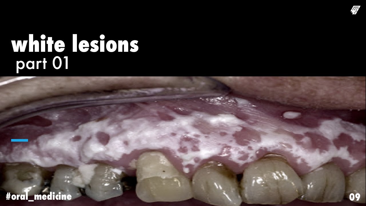 white lesions || oral keratosis || oral medicine _ عزت شومان