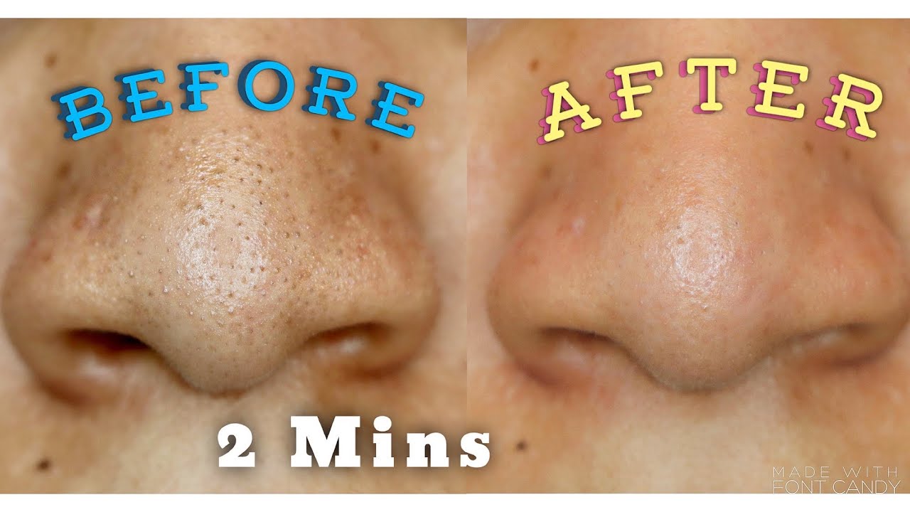 DERMAFLASH DERMAPORE EXTRACTOR AND SERUM REVIEW AND DEMO | Does This Really Work??