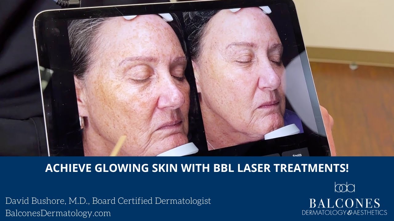 Achieve Glowing Skin with BBL Laser Treatments! | David Bushore, MD, FAAD | Austin, TX