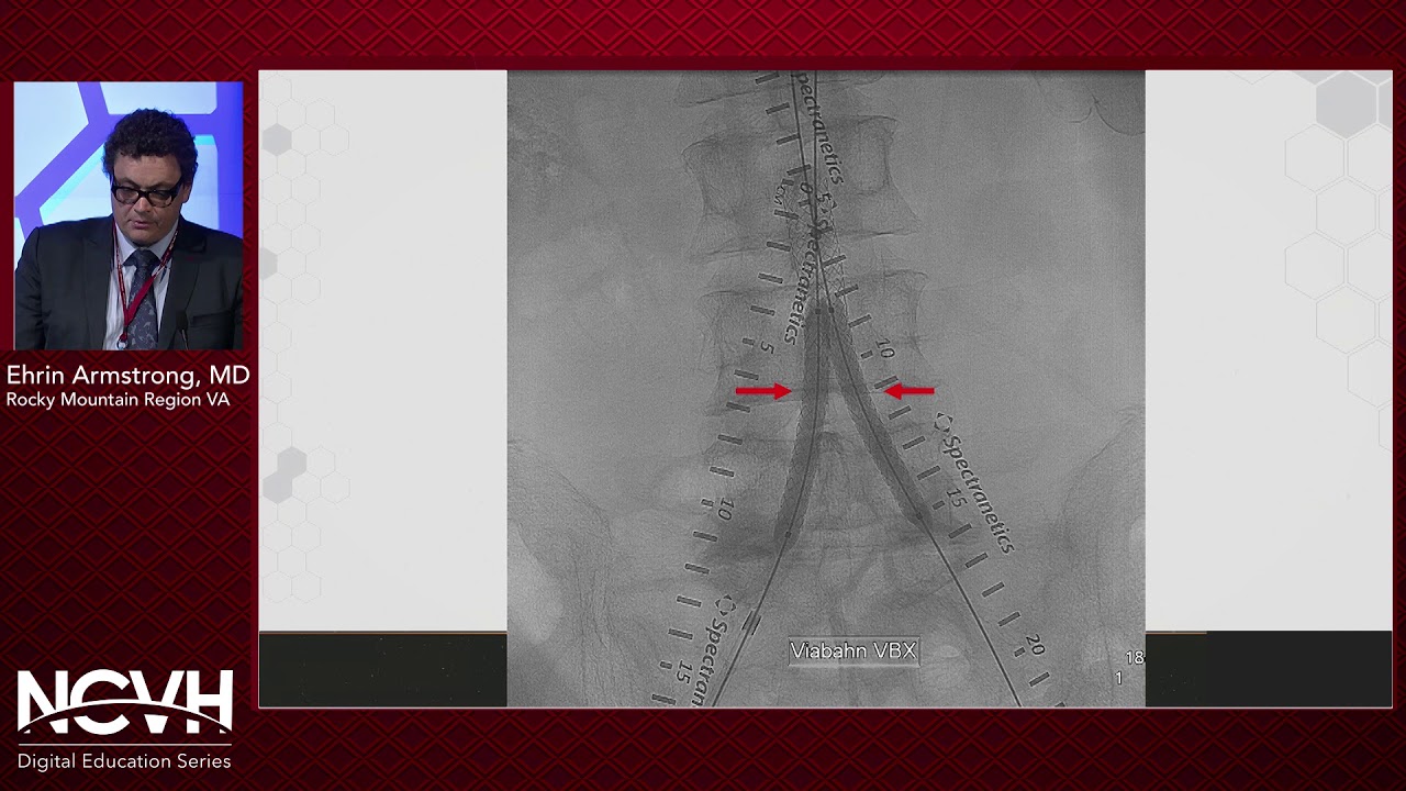 Dr. Ehrin Armstrong, Endovascular Treatment of Advanced Aortoiliac Disease