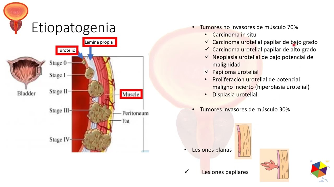 Epidemiologia del carcinoma superficial de vejiga. Dr. Hugo Castro, Oncólogo, Grupo Medico Angeles