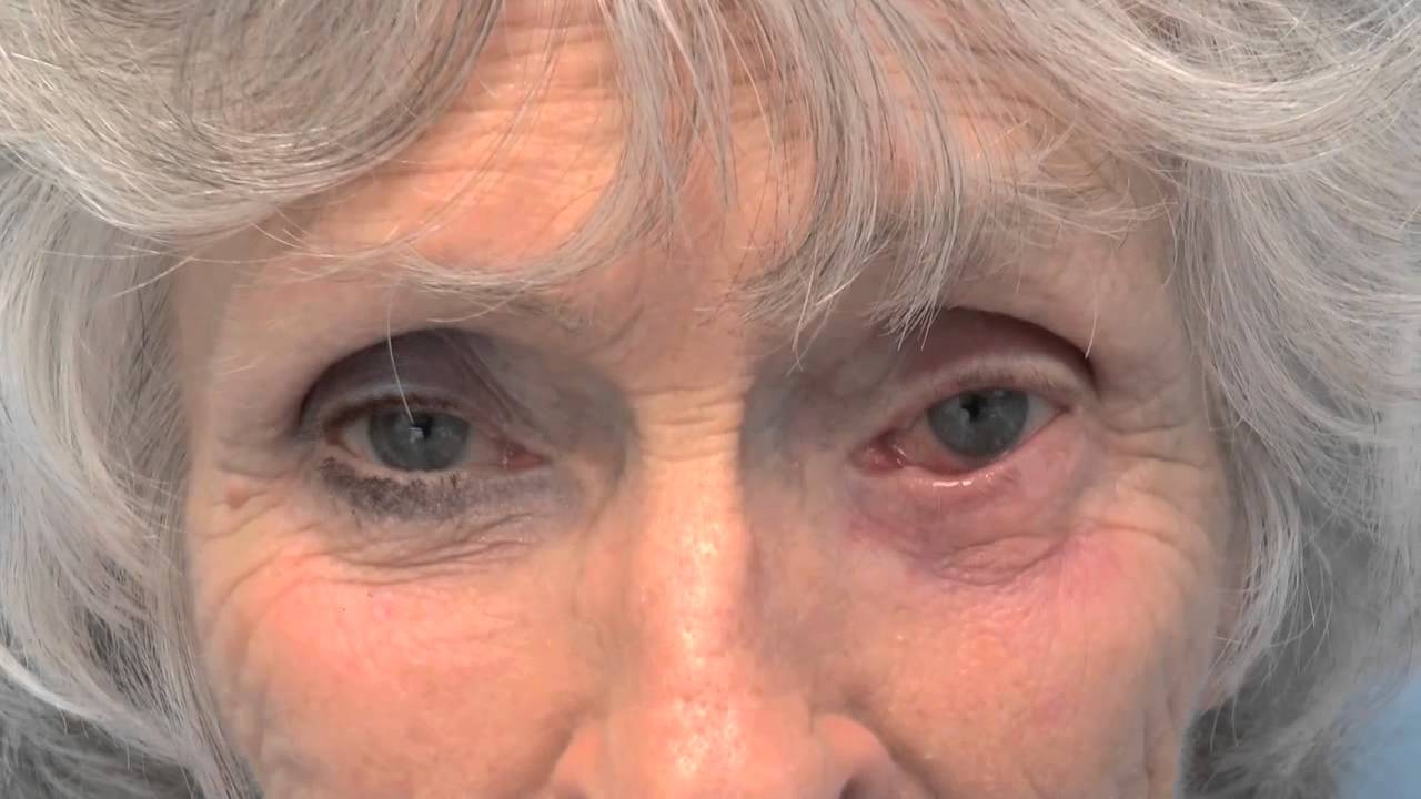 REPAIR OF MEDIAL ECTROPION - DR. TANVEER JANJUA - NEW JERSEY