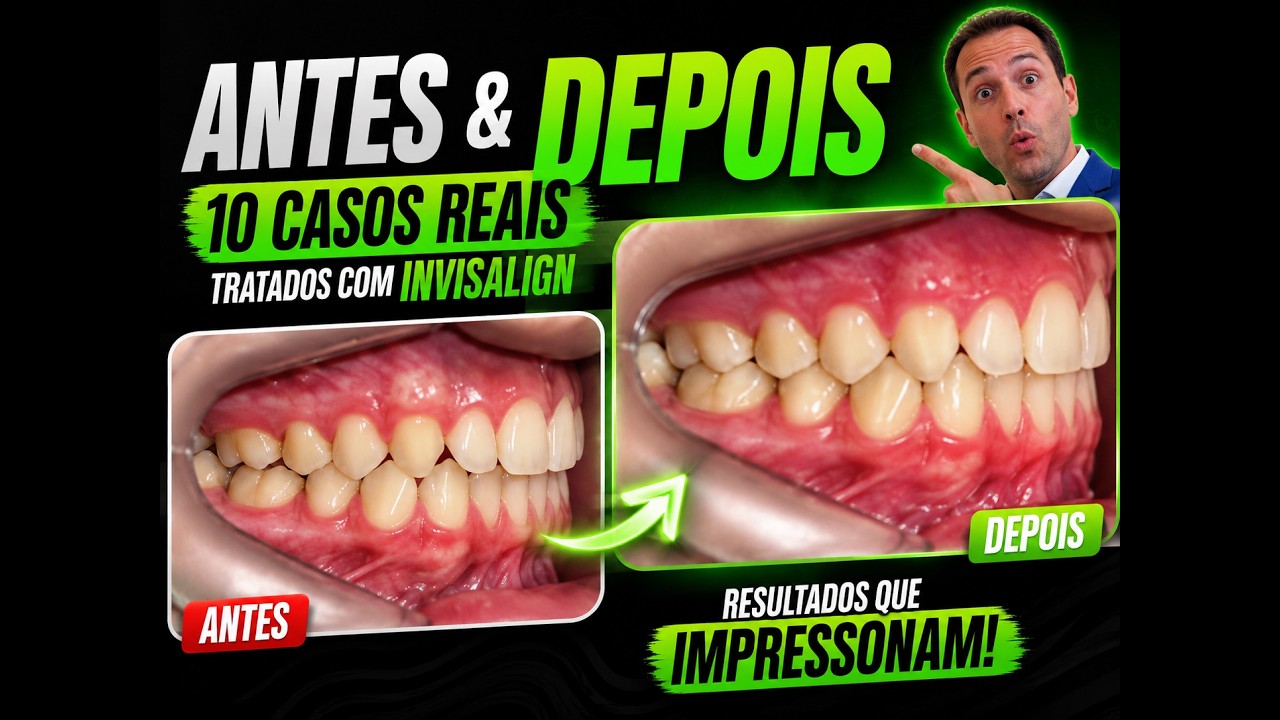 Antes e depois. 10 casos tratados com Invisalign.