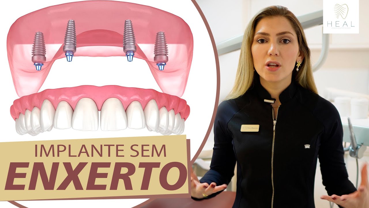 Implante Dentário Sem Enxerto em 1 Dia, Protocolo All on 4 - Heal Odontologia