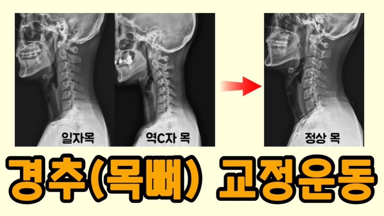 일자목, 역C자목 교정 프로젝트 2탄 (편평등/일자흉추/목통증/가슴통증/등통증)