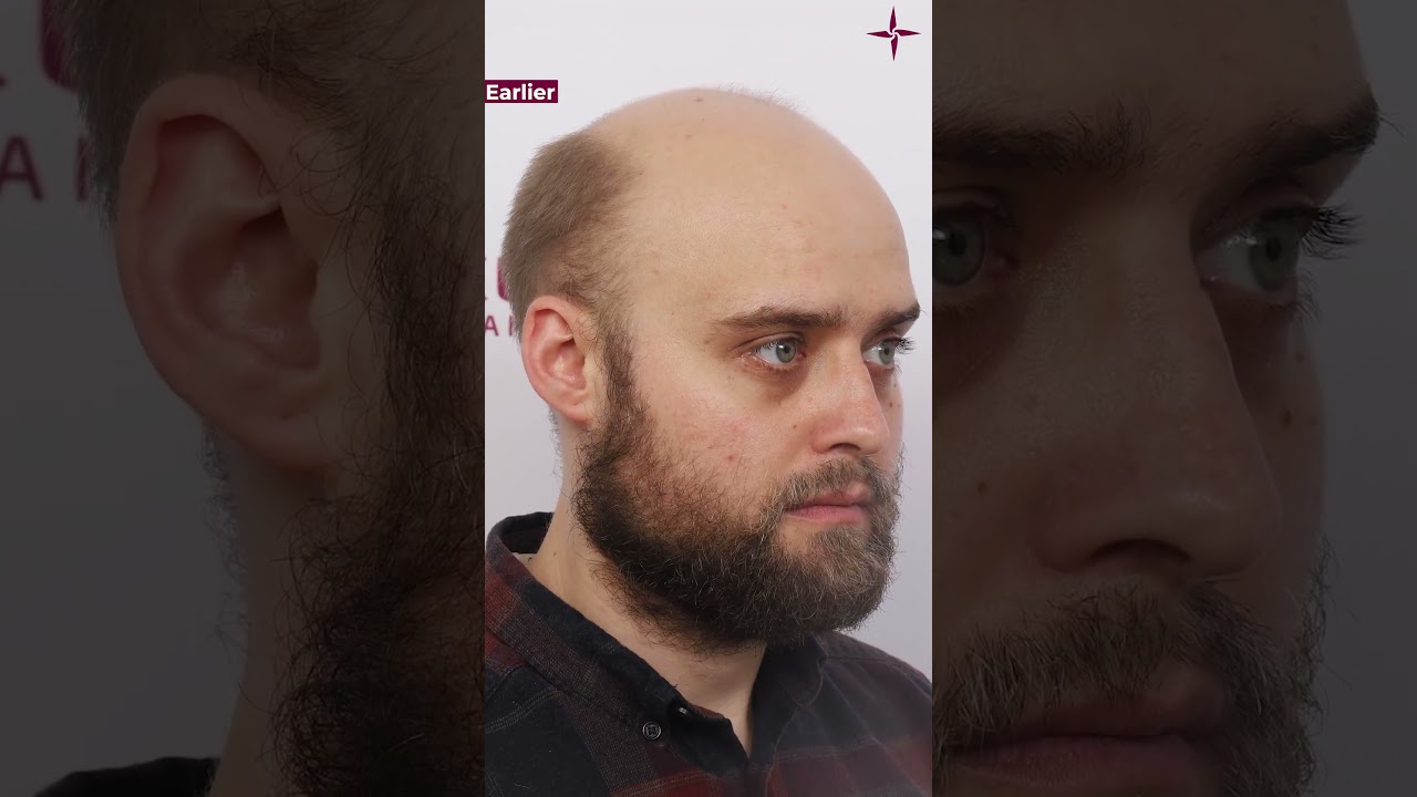Inspiring Hair Transplant Results: A Journey from United Kingdom to Eugenix!