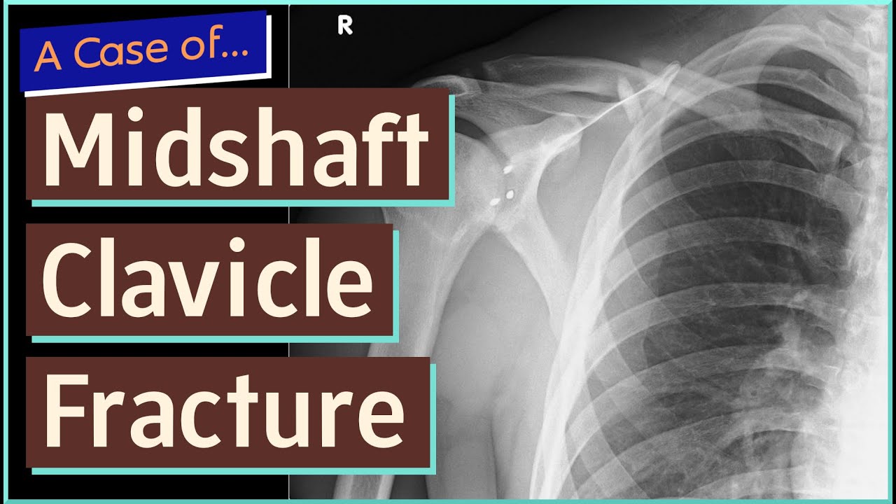 Mid Shaft Clavicle Fracture